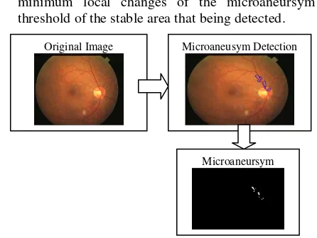 Fig. 4. Microaneursym Segmentation Process 