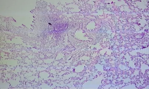 Gambar 3. Fokus limfoid di alveoli, ditunjukkan