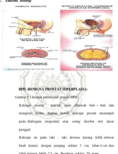 Gambar 2.1 normal prostat and  prostat BPH 
