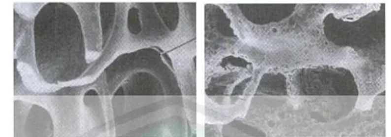 Gambar 1.1 : (a)gambar struktur tulang normal. (b)gambar struktur tulang yang  terkena osteoporosis