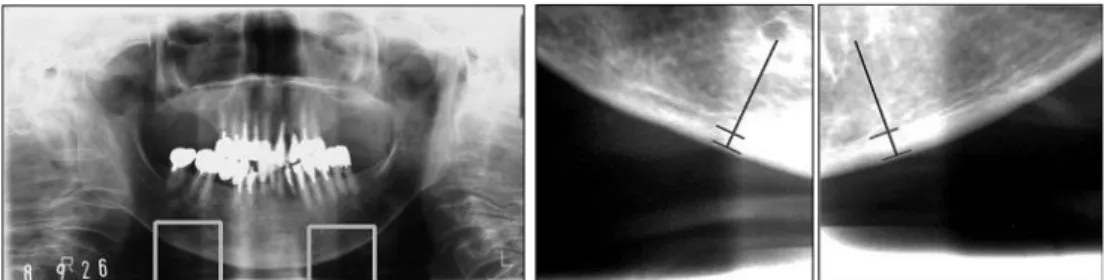 Gambar 1.3: Pengukuran lebar cortical bone kiri dan kanan. Sumber: Agus, 2005 