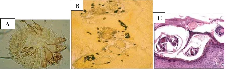 Gambar 2.1. (A) Potongan mikroskopis tungau  esoin) menunjukkan sebuah terowongan dengan tungau skabies pada bagian Sarcoptes scabiei menunjukkan kedelapan kaki dan alat untuk menggigit