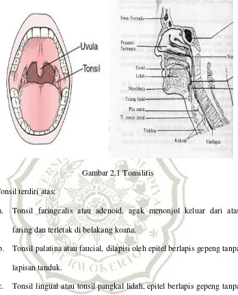 Gambar 2.1 Tonsilitis 