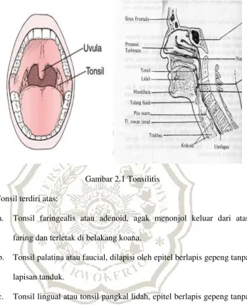 Gambar 2.1 Tonsilitis 