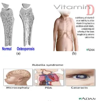 Gambar 1.6 (a). Tulang nirmal dan tulang osteoporosis, (b). Kekurangan vitamin D,(c). mikrosefalus