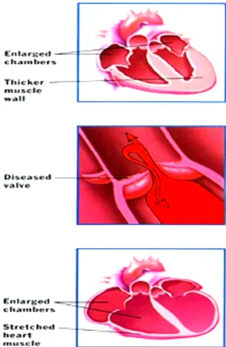 Gambar 1.  Perubahan anatomi jantung