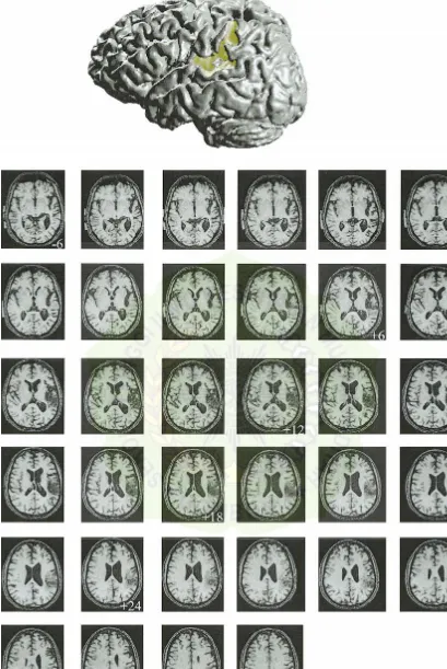 FIG. 1.An illustration of the anatomy of RC’s cerebral infarct. In the top row, RC’s brain visualized in a three-dimensional rendering ofthe cortical surface obtained from structural MRI data