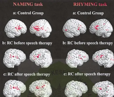 FIG. 2.A rendering showing the regions activated for (1) the Naming task and (2) the Rhyming task of (a) the control group, (b) RC beforethe speech therapy, and (c) RC after the speech therapy