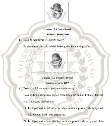 Gambar : 2.1 Frank Breech 
