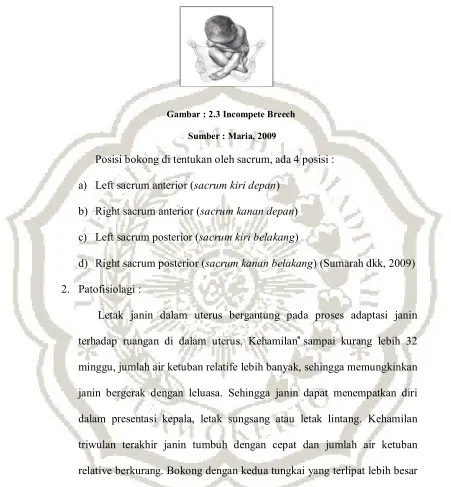 Gambar : 2.3 Incompete Breech 