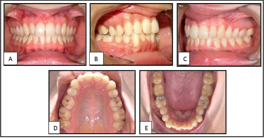 Gambar 1. Fotometri intra oral. A. Foto pandangan frontal dalam keadaan oklusi, B. Foto pandangan bukal sebelah kanan dalam keadaan oklusi, C