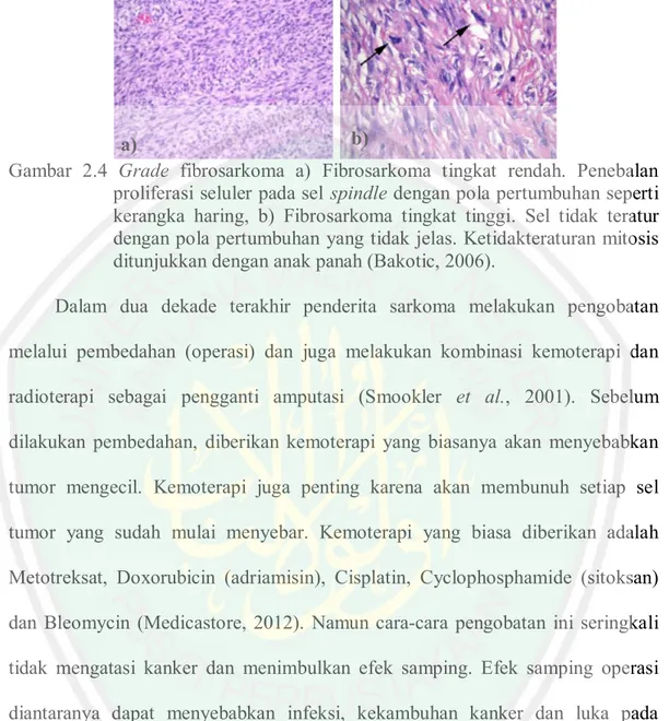 Gambar 2.4 Grade fibrosarkoma a) Fibrosarkoma tingkat rendah. Penebalan proliferasi seluler pada sel spindle dengan pola pertumbuhan seperti kerangka haring, b) Fibrosarkoma tingkat tinggi