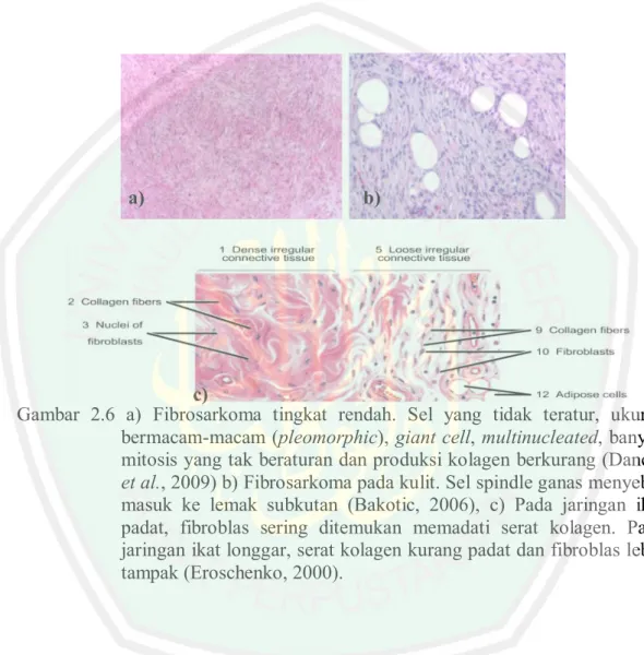 Gambar 2.6 a) Fibrosarkoma tingkat rendah. Sel yang tidak teratur, ukuran bermacam-macam (pleomorphic), giant cell, multinucleated, banyak mitosis yang tak beraturan dan produksi kolagen berkurang (Danciu et al., 2009) b) Fibrosarkoma pada kulit