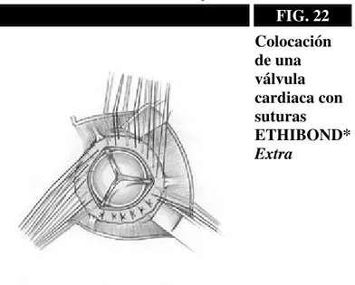 FIG. 22  Colocación  de una  válvula  cardiaca con  suturas  ETHIBOND*  Extra 