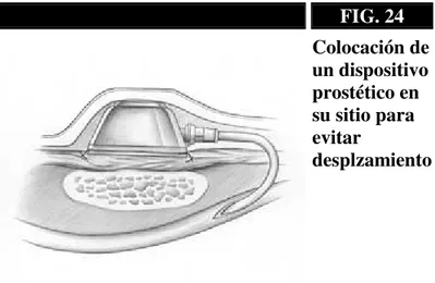 FIG. 24  Colocación de  un dispositivo  prostético en  su sitio para  evitar  desplzamiento