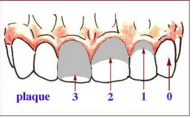 Gambar 3: Indeks Plak (Sumber: Daliemunthe SH.Periodonsia. USU Press, 2008:56) 