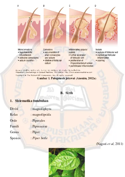 Gambar 1. Patogenesis jerawat (Anonim, 2012a)