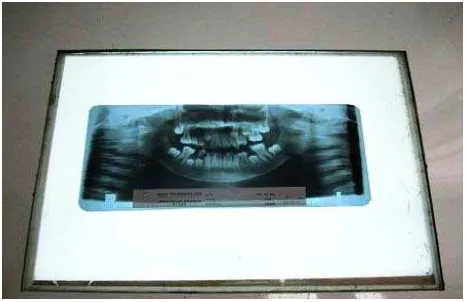 Gambar 4. Foto radiografi panoramik yang diletakkan di                                                Tracing Box 