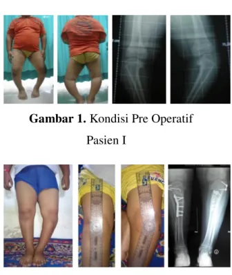Gambar 2. Kondisi Post-Operasi Pasien  I 
