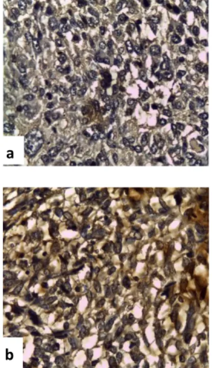 Gambar  2.  Sayatan  pada  jaringan  osteosarkoma  dengan  pewarnaan  IHC  menggunakan antibodi monoclonal terhadap  IL-10