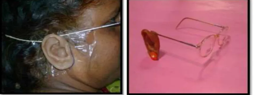 Gambar 2. Eyeglasses Retention (kaca mata) 