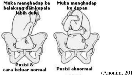 Gambar 4. Posisi janin normal dan abnormal dalam rahim ibu
