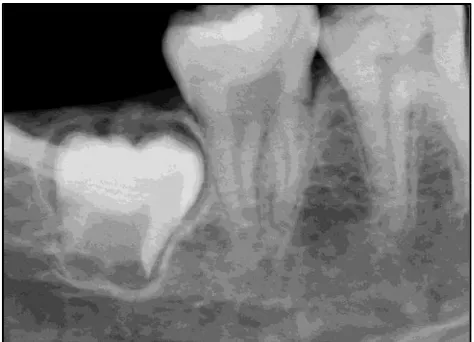 Gambar 6. Hasil radiografi periapikal19 