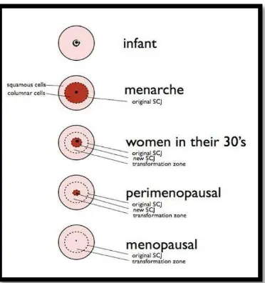 Gambar 2.4. Zona transformasi pada berbagai kelompok umur Dikutip dari Comprehensive Cervical Cancer Control, WHO