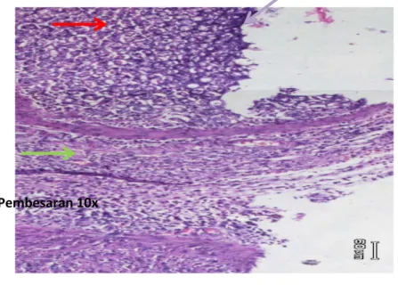 Gambar 5. Gambaran mikroskopik lambung tikus wistar Perlakuan D pada pembesaran 10x.. Tampak  lapisan mukosa(panah merah), erosi (panah ungu), radang (panah jingga), metaplasia intestinal (panah  hitam) dan nekrosis (hijau muda)