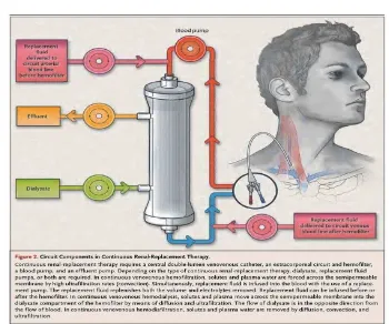 Gambar 2.1. Hemodialisis 