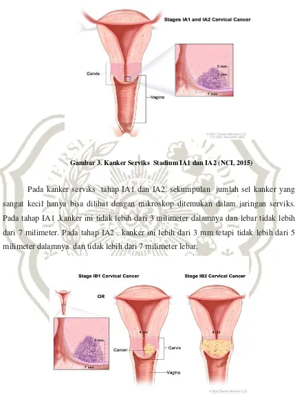 Gambar 3. Kanker Serviks  Stadium IA1 dan IA2 (NCI, 2015) 