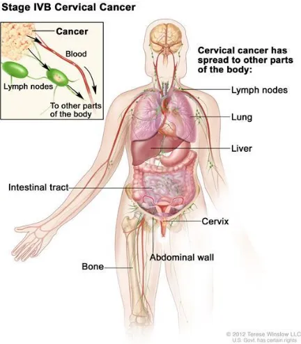 Gambar 7. Kanker serviks  tahap IIIB (NCI, 2015) 