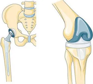 Gambar 1. Contoh implan panggul (kiri) dan lutut  (kanan) (SMART-Servier Medical Art, 2019) 