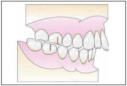 Gambar 3. Maloklusi Klas II divisi 1 6 