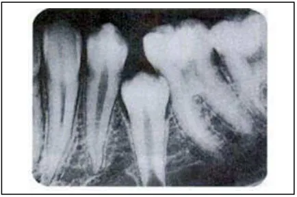 Gambar 10.  Impaksi gigi karena premature              loss gigi molar desidui37  