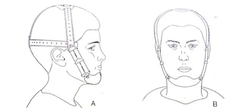 Gambar 3. Occipital Pull Chin Cap dengan Daya Diarahkan Melewati  Bagian Atas dan Depan Kondilus 7