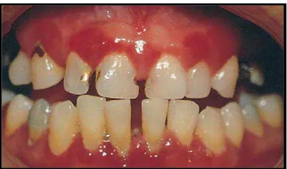 Gambar 5. Gingivitis difus tergeneralisasi yang melibatkan margin gingiva, papila interdental, dan gingiva cekat26 