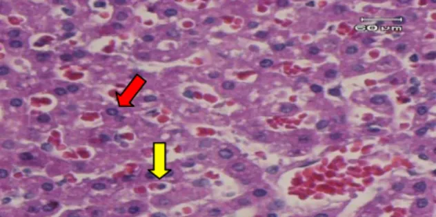 Gambar 4. Gambaran mikroskopik hati tikus  wistar yang diberikan CCl 4   dilanjutkan  pemberian pellet biasa selama 5 hari