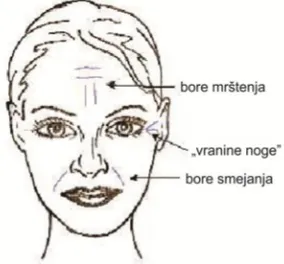 Figure 1.  Types of wrinkles on the face    