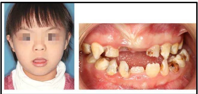 Gambar 2.2 Manifestasi oral pada anak sindrom Down.2 