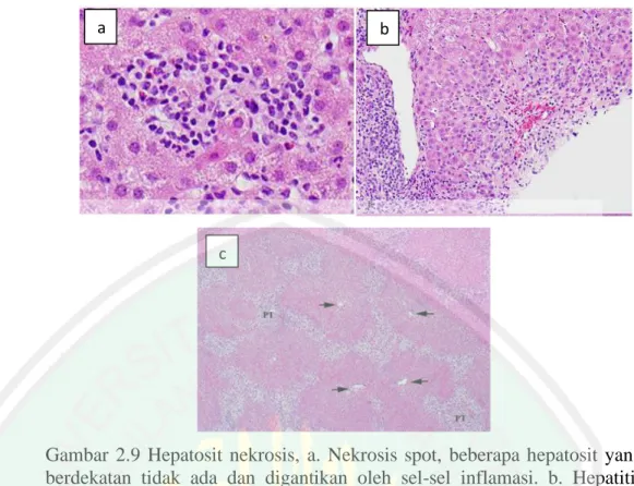 Gambar  2.9  Hepatosit  nekrosis,  a.  Nekrosis  spot,  beberapa  hepatosit  yang  berdekatan  tidak  ada  dan  digantikan  oleh  sel-sel  inflamasi