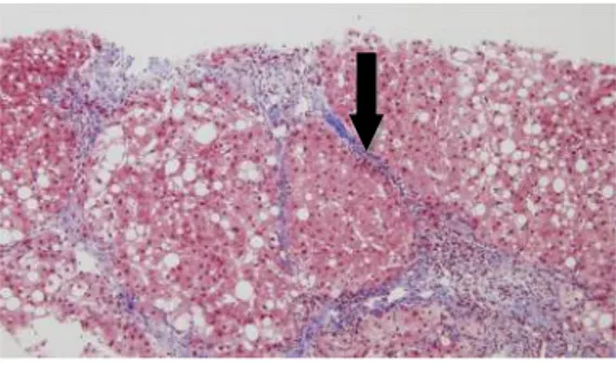 Gambar  2.10  Septa  fibrosis  pada  kasus  sirosis  (panah  hitam)  (pewarnaan  Masson’s trichrome) (Lo, 2017)