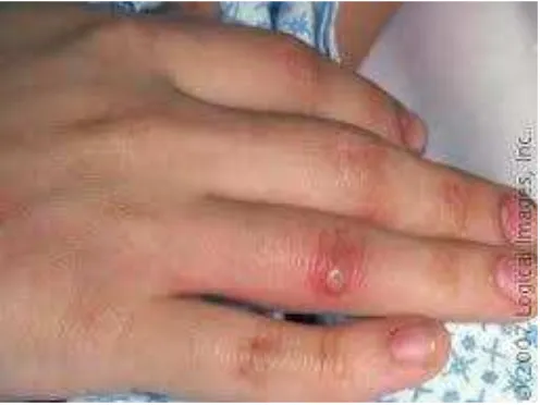 Gambar 4. Keluhan kesehatan kulit karena alergi 