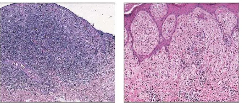 Gambar 2.1 Absent (Sumber : Busam, K. J., Antonescu, C. R., Marghoob, A. A. Classification of Tumor-Infiltrating Lymphocytes in Primary Cutaneous Malignant Melanoma dan nonbrisk tumor infiltrating lymphocytes