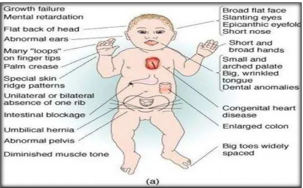 Gambar 3. Keadaan tubuh anak sindrom Down10 