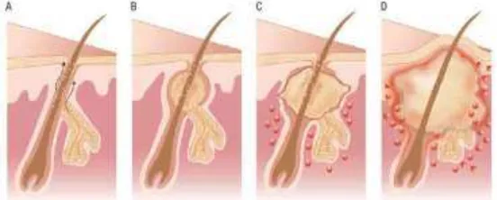 Gambar 2.3 Patogenesis Akne Vulgaris: (a) Mikrokomedo, (b) komedo, (c) 