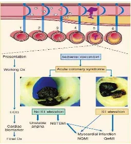 Gambar 4. Patofisiologi terjadinya sindroma koroner akut (Hamm dkk,2004) 