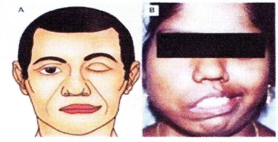 Gambar 2.2. Gambaran klinis Bell‘sPalsy 