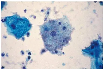 Gambar 2.7. Mikroskop Vaginosis Bakterial Sumber: Pathology Outlines (2013)  