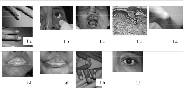 Gambar 1. Ekstra Oral dan Histopatologi 